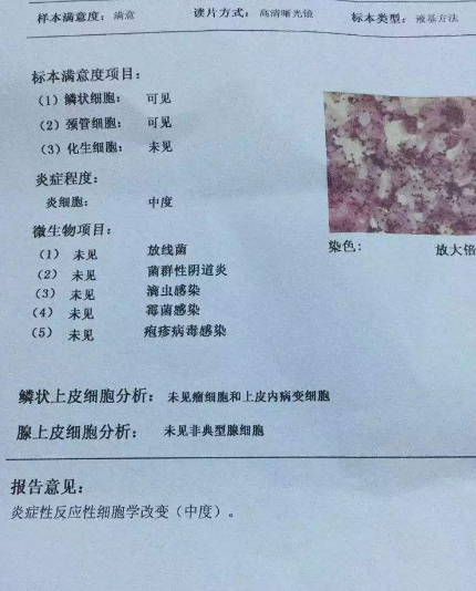 陰道分泌物深夜福利影院廠家教你查看陰道分泌物檢測報告