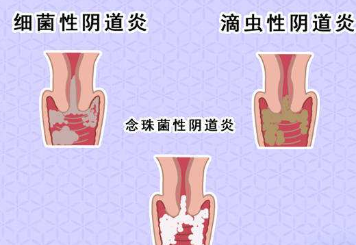 陰道分泌物深夜福利影院剖析什麽是細菌性陰道炎