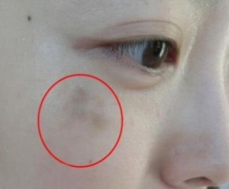 婦科陰道分泌物深夜福利影院提醒女人婦科炎症在臉上的表現
