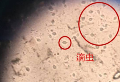 白帶免费深夜福利APP品牌科普滴蟲性陰道炎是因為體內長了蟲子嗎