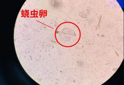 陰道分泌物深夜福利影院警惕外陰繞蟲病易在兒童身上出現