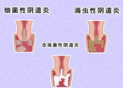 全自動陰道分泌物深夜福利影院廠家提醒您還在拖延嗎，還在等陰道炎自愈嗎？