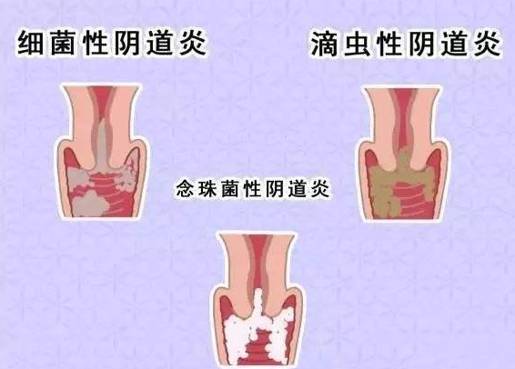 全自動陰道分泌物深夜福利影院廠家提醒您還在拖延嗎，還在等陰道炎自愈嗎？